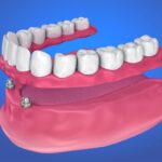 Storia degli impianti dentali: chi li ha inventati?